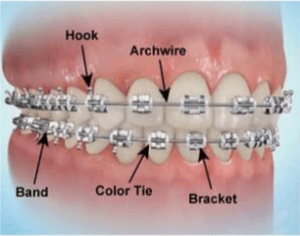 diagram of parts of braces