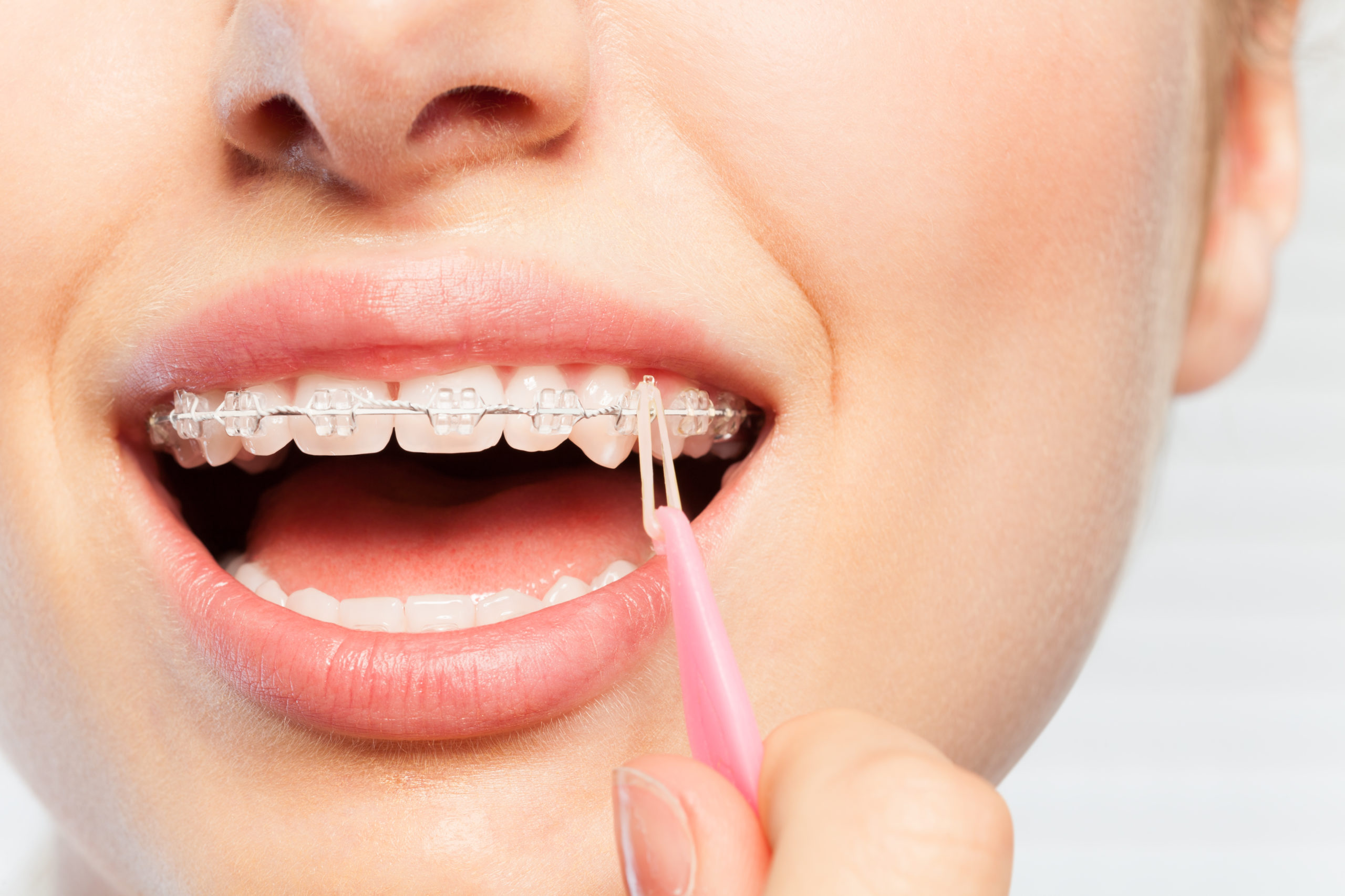 Elastic Chain Dental Definition at Stacey Dyer blog