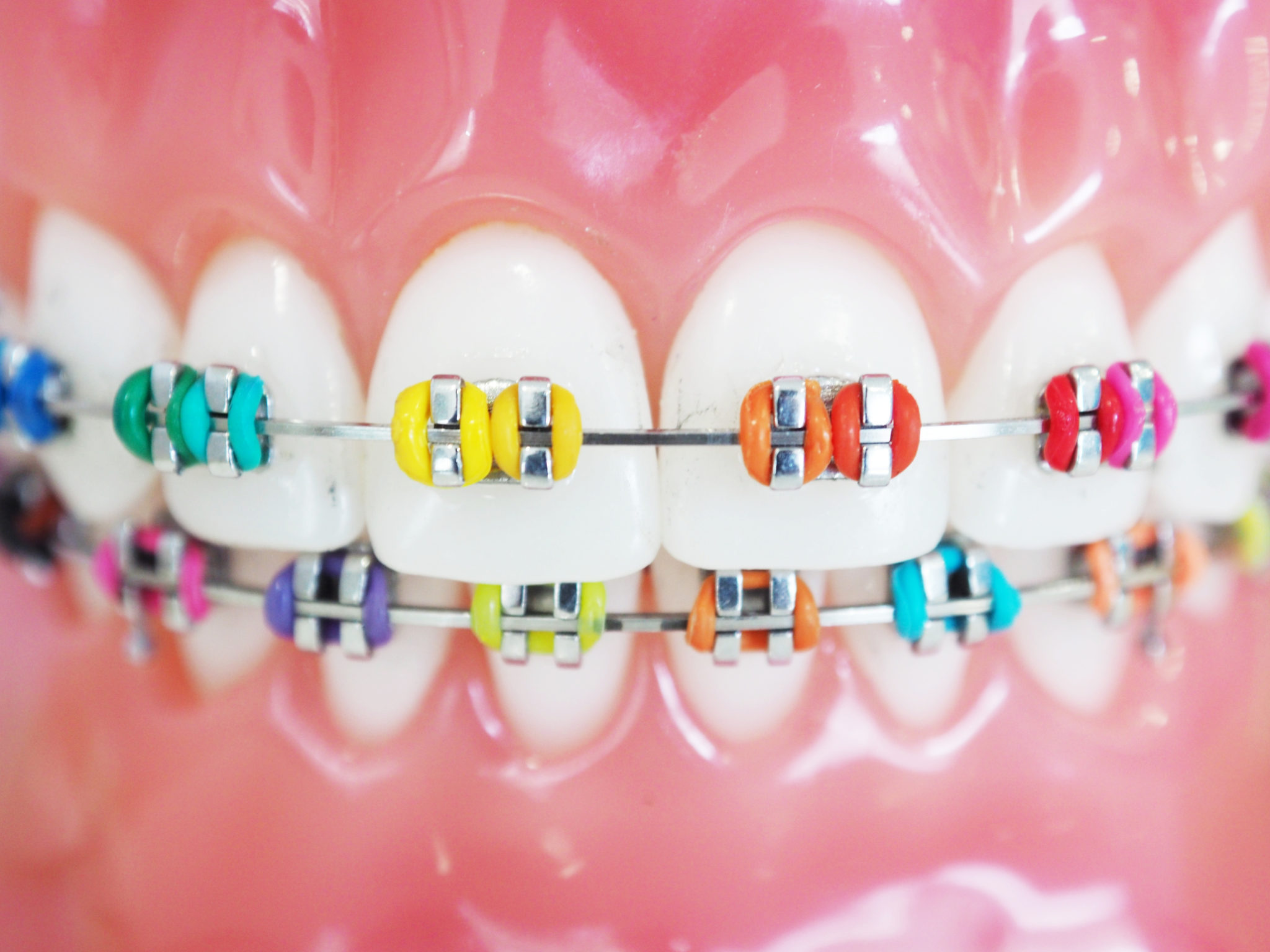 The Different Parts Of Your Braces Swan Orthodontics